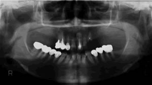 治療前レントゲン