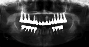 治療後レントゲン
